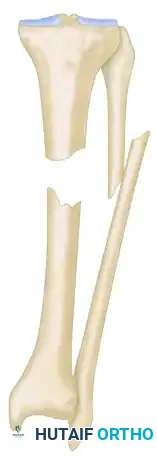 GENERAL TREATMENT OF NONUNIONS Surgical Diagram