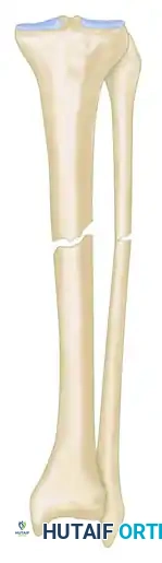 GENERAL TREATMENT OF NONUNIONS Surgical Diagram