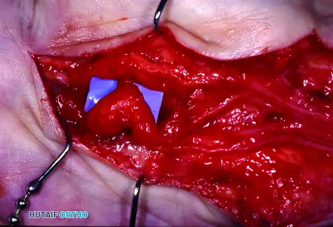 GIANT CELL TUMOR OF THE TENDON SHEATH (XANTHOMA) Surgical Diagram