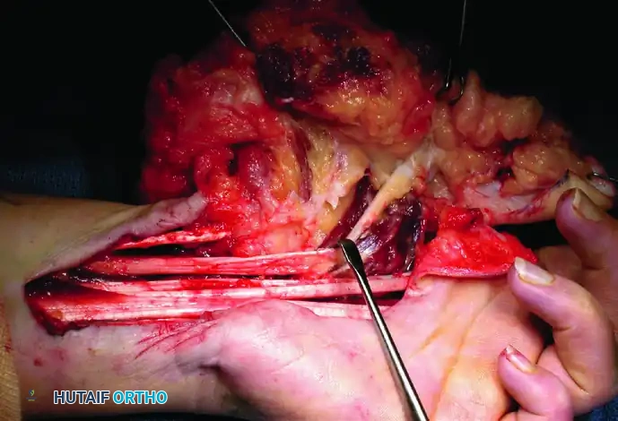 GIANT CELL TUMOR OF THE TENDON SHEATH (XANTHOMA) Surgical Diagram