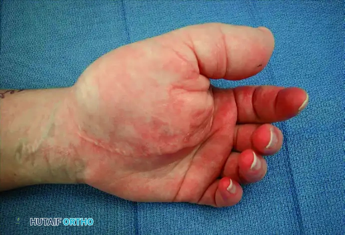 GIANT CELL TUMOR OF THE TENDON SHEATH (XANTHOMA) Surgical Diagram