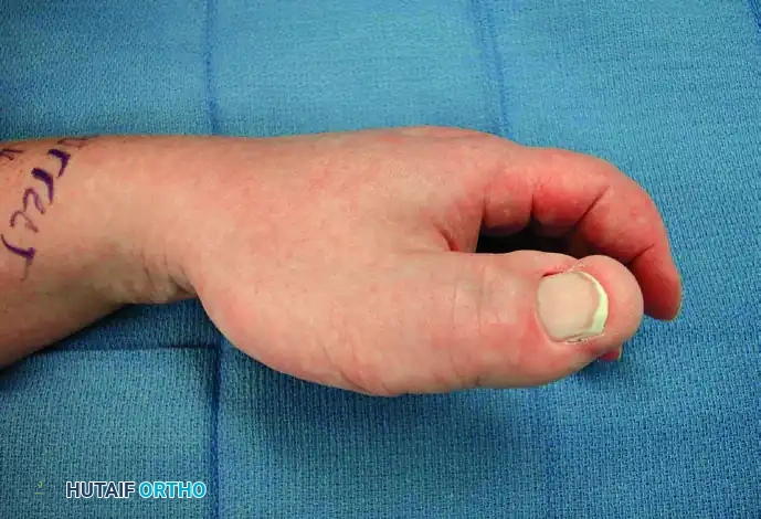 GIANT CELL TUMOR OF THE TENDON SHEATH (XANTHOMA) Surgical Diagram