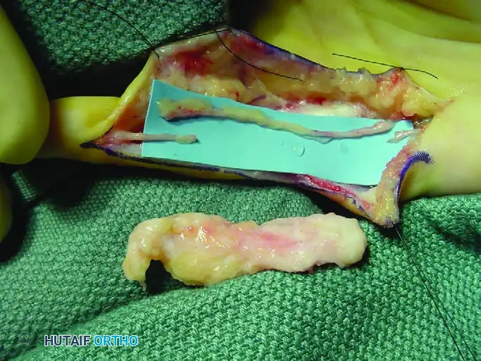 GIANT CELL TUMOR OF THE TENDON SHEATH (XANTHOMA) Surgical Diagram