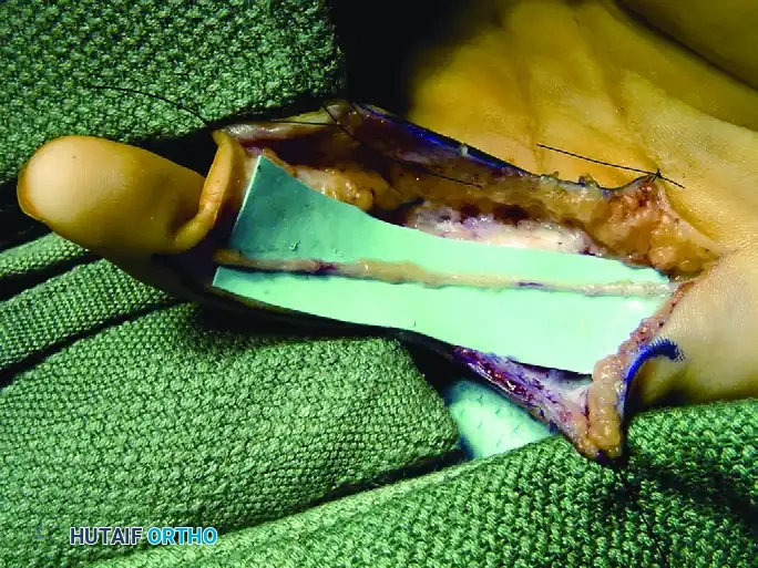 GIANT CELL TUMOR OF THE TENDON SHEATH (XANTHOMA) Surgical Diagram