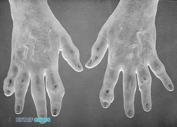 Operative Management of Gout and Scleroderma in the Hand