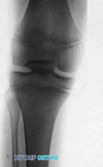 Mastering Knee Dislocations and Intraarticular Patellar Reductions: A Comprehensive Surgical Guide