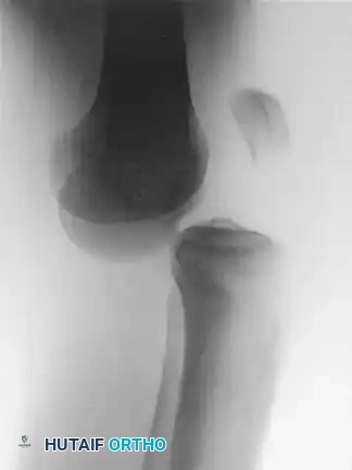 GRAFTING OF THE MEDIAL PATELLAR RETINACULUM Surgical Diagram
