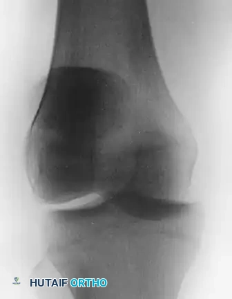 FIGURE 60-3 Intraarticular horizontal dislocation of patella. Quadriceps mechanism usually remains intact.