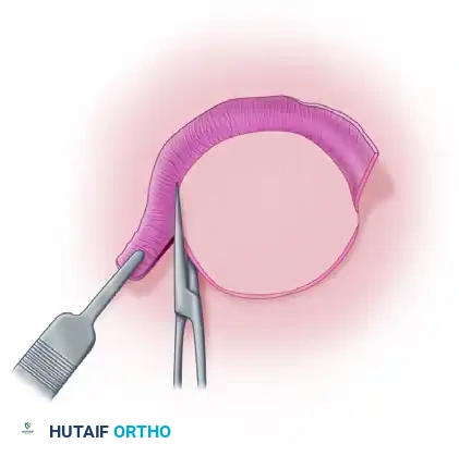 GRAFTS AND FLAPS Surgical Diagram