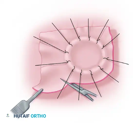 GRAFTS AND FLAPS Surgical Diagram