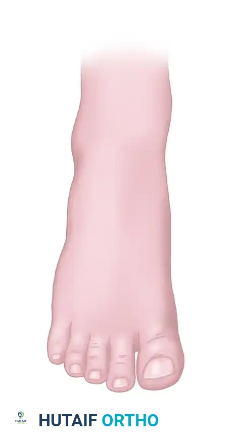 Great Toe Wraparound Flap Transfer: Surgical Technique