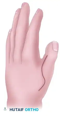 Surgical Management of Group 2 Clasped Thumb Deformity and Hypoplastic Digits