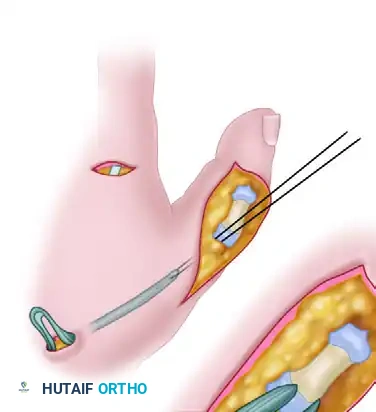 GROUP 2 CLASPED THUMB DEFORMITY Surgical Diagram