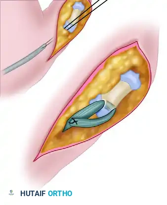 GROUP 2 CLASPED THUMB DEFORMITY Surgical Diagram
