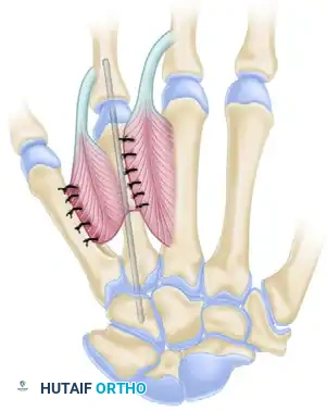 Surgical Management of Group 3 Clasped Thumb Deformity and Brachymetacarpia