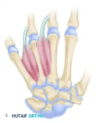 Buck-Gramcko Technique - Interposition Graft and Fixation