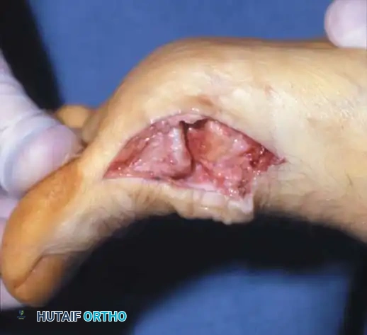 Fig. 78-85 Hallux rigidus. A, Marked limitation of metatarsophalangeal extension. B and C, Dorsal osteophyte and degenerative changes. D, Increased extension after joint débridement.