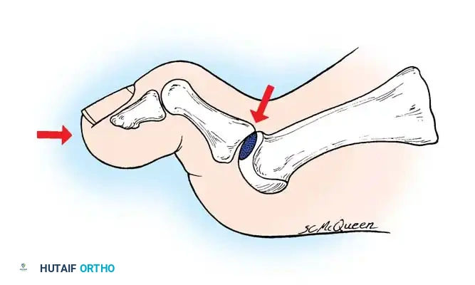 Fig. 78-86 Location of chondral or osteochondral lesion produced by forceful extension and impaction of metatarsal head. (Redrawn from McMaster MJ: The pathogenesis of hallux rigidus, J Bone Joint Surg 60B:82, 1978.)