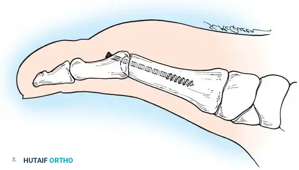 HALLUX RIGIDUS Surgical Diagram