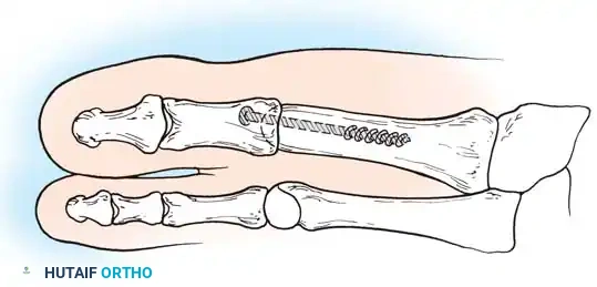 HALLUX RIGIDUS Surgical Diagram