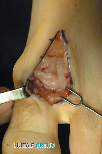Fig. 78-91 Cheilectomy. A, Patient with stage II (radiographically) hallux rigidus; note dorsal osteophyte over ﬁ rst metatarsal. B, Incision is placed at lateral border of extensor hallucis longus. C, Dorsal sensory nerve to hallux is protected. D, First metatarsophalangeal joint is exposed. E, Dorsal osteophytes are removed