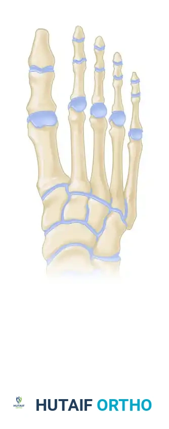 FIGURE 83-12 Fixed flexion contracture of proximal interphalangeal joint with flexible metatarsophalangeal and distal interphalangeal joints.