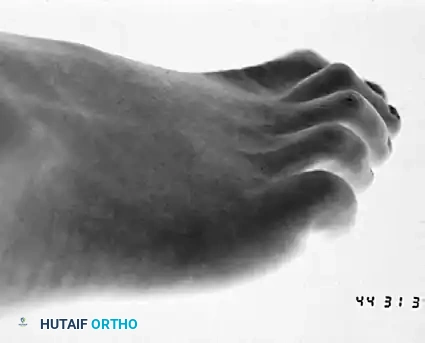 HAMMER TOE AND CLAW TOE Surgical Diagram