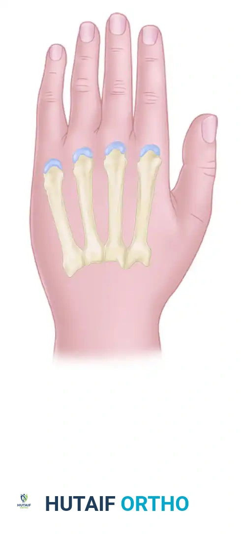 HAND FASCIOTOMIES Surgical Diagram