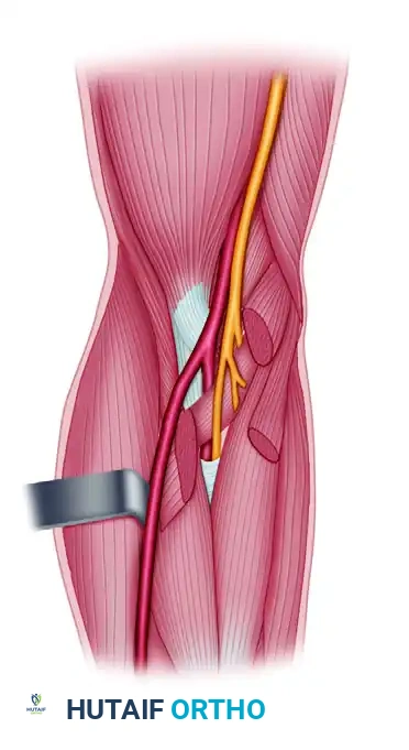 HAND FASCIOTOMIES Surgical Diagram