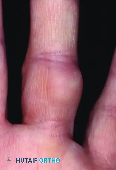 HEMANGIOMA Surgical Diagram