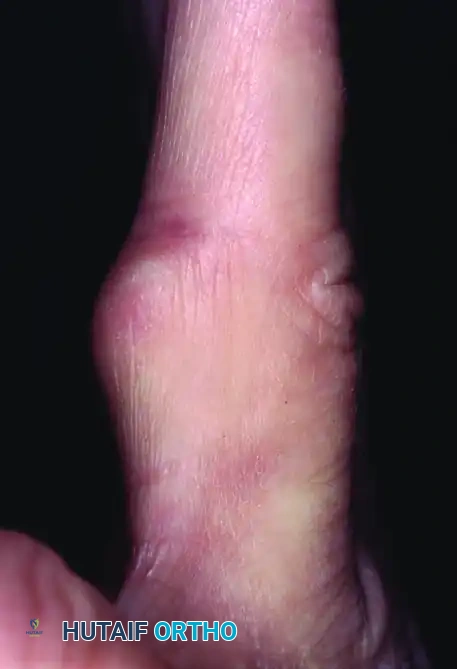 HEMANGIOMA Surgical Diagram