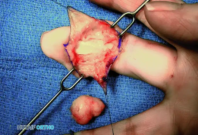HEMANGIOMA Surgical Diagram