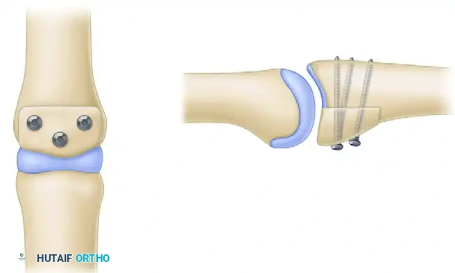 HEMI-HAMATE AUTOGRAFT Surgical Diagram