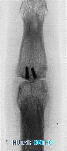 HEMI-HAMATE AUTOGRAFT Surgical Diagram