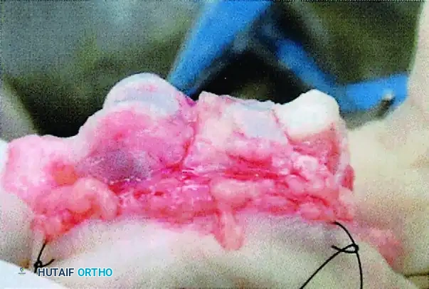HEMI-HAMATE AUTOGRAFT Surgical Diagram