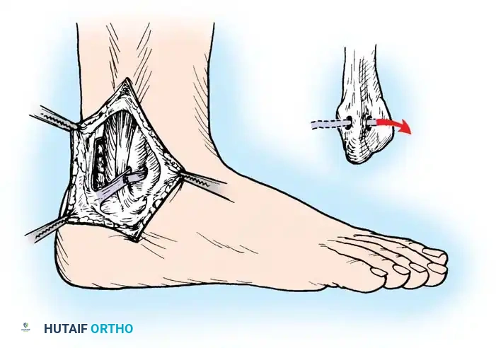 Fig. 46-39 Jones technique for displacement of peroneal tendons. Check that ligament formed by flap of Achilles tendon is inserted through hole drilled in lateral malleolus.