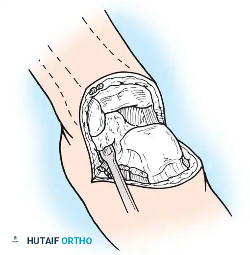 Subperiosteal dissection of calcaneus
