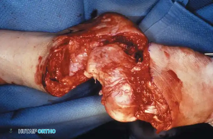 Fig. 10-19 Syme amputation. A, Incision and bone level. B, Exposure of ankle and division of ligaments. C, Bone hook pulling talus distally, exposing distal articular surface of tibia and ﬁ bula. D, Dissection of soft tissues from calcaneus. E and F, Subperiosteal removal of calcaneus, leaving heel pad intact. Continued