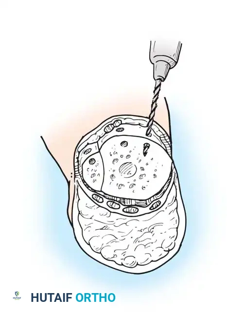 Septa of heel fat pad