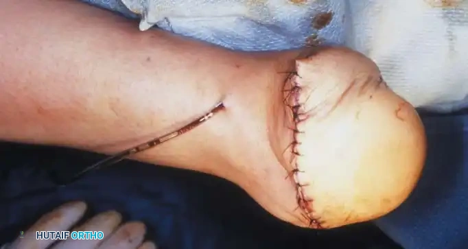 Fig. 10-19, cont’d G, Division of tibia and ﬁ bula just through dome of ankle joint centrally. H, Holes drilled in anterior edge of tibia and ﬁ bula to anchor heel pad. I, Edge of deep fascia lining heel pad is anchored to tibia and ﬁ bula. J and K, Skin closure over drain, and application of above-knee cast.