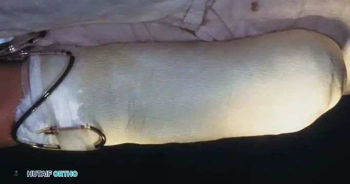 HINDFOOT AND ANKLE AMPUTATIONS Surgical Diagram