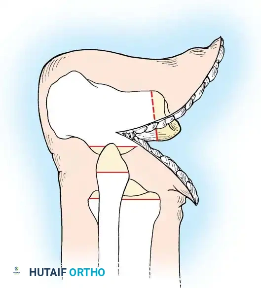 صورة شعاعية للبدائل الجراحية