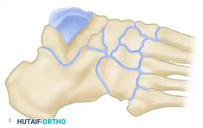 HINDFOOT Surgical Diagram