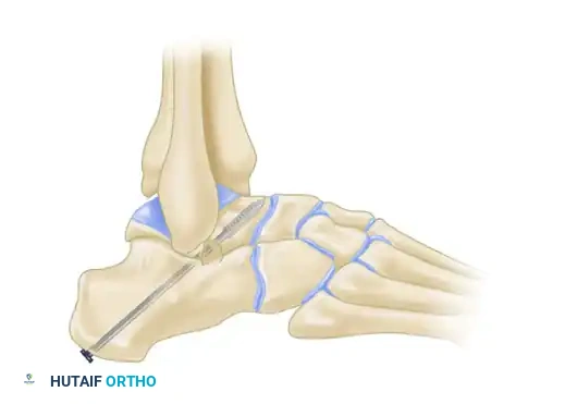 HINDFOOT Surgical Diagram