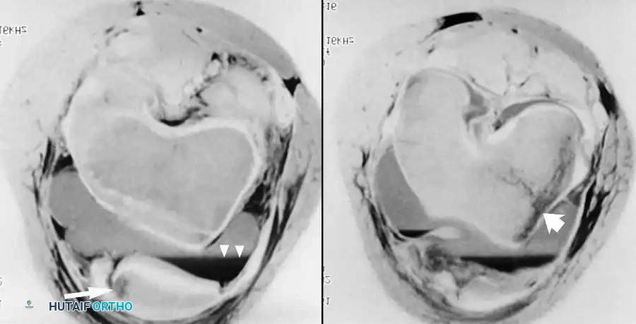 صورة تظهر خلع الرضفة والكدمات العظمية