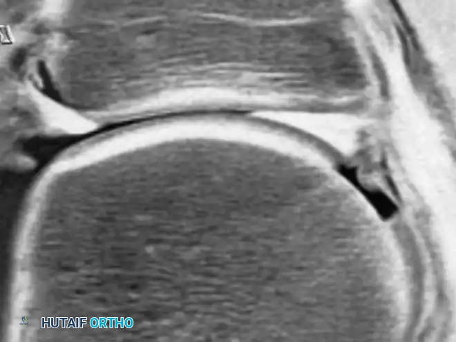 صورة تظهر آفة غضروفية دقيقة