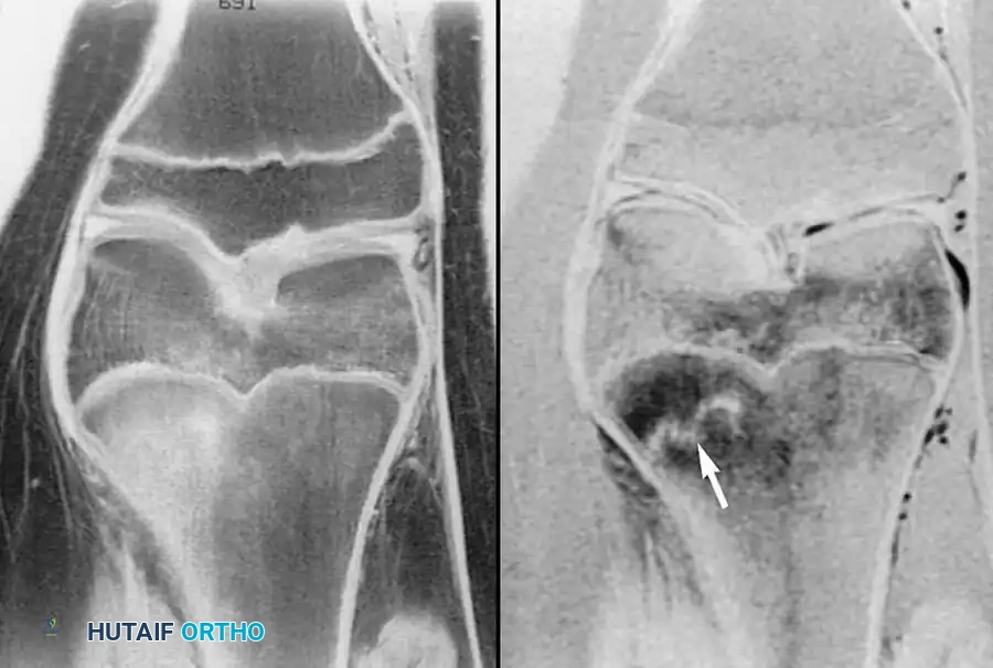 صورة تظهر كسرا خفيا في عظم الفخذ البعيد