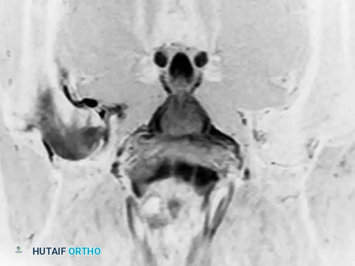 صورة توضح هشاشة العظام العابرة في الورك الجزء الثاني