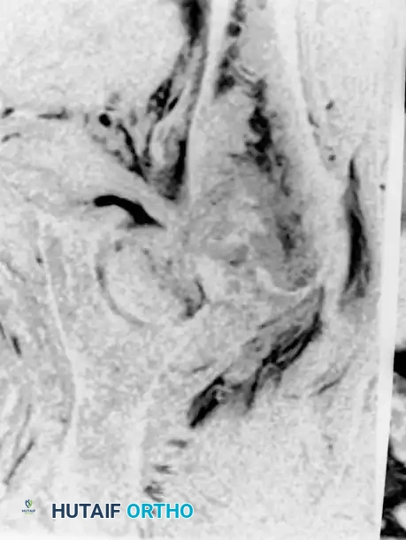 صورة تظهر كسرا خفيا في مفصل الورك الجزء الثالث