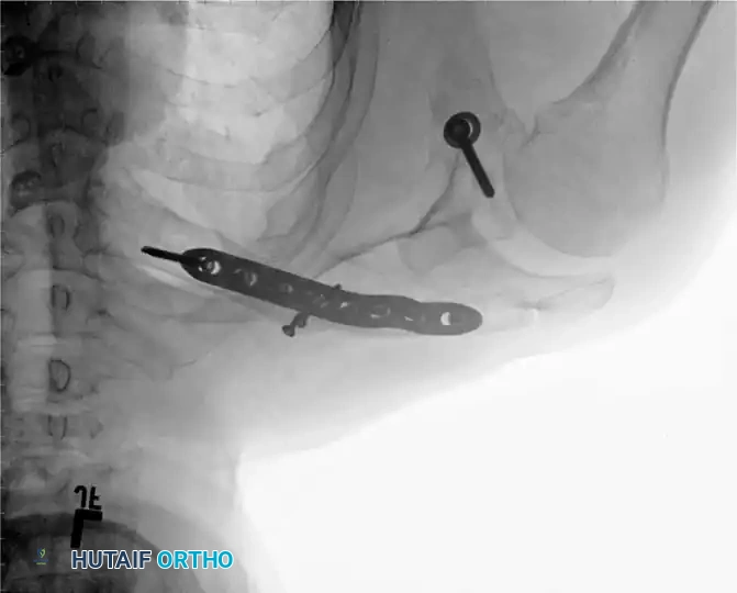 Surgical Management of Proximal Humerus & Clavicle Malunions